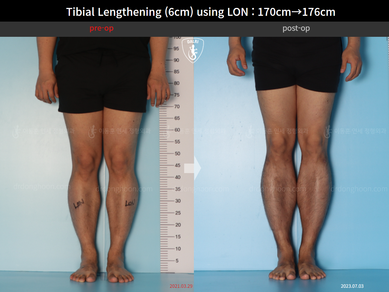 Before and after cll lon, case 15623962, image 6, Dr. Donghoon institute (DALRI)