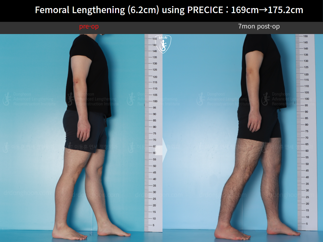 Before and after cll precice, case 20671201, image 6, Dr. Donghoon institute (DALRI)
