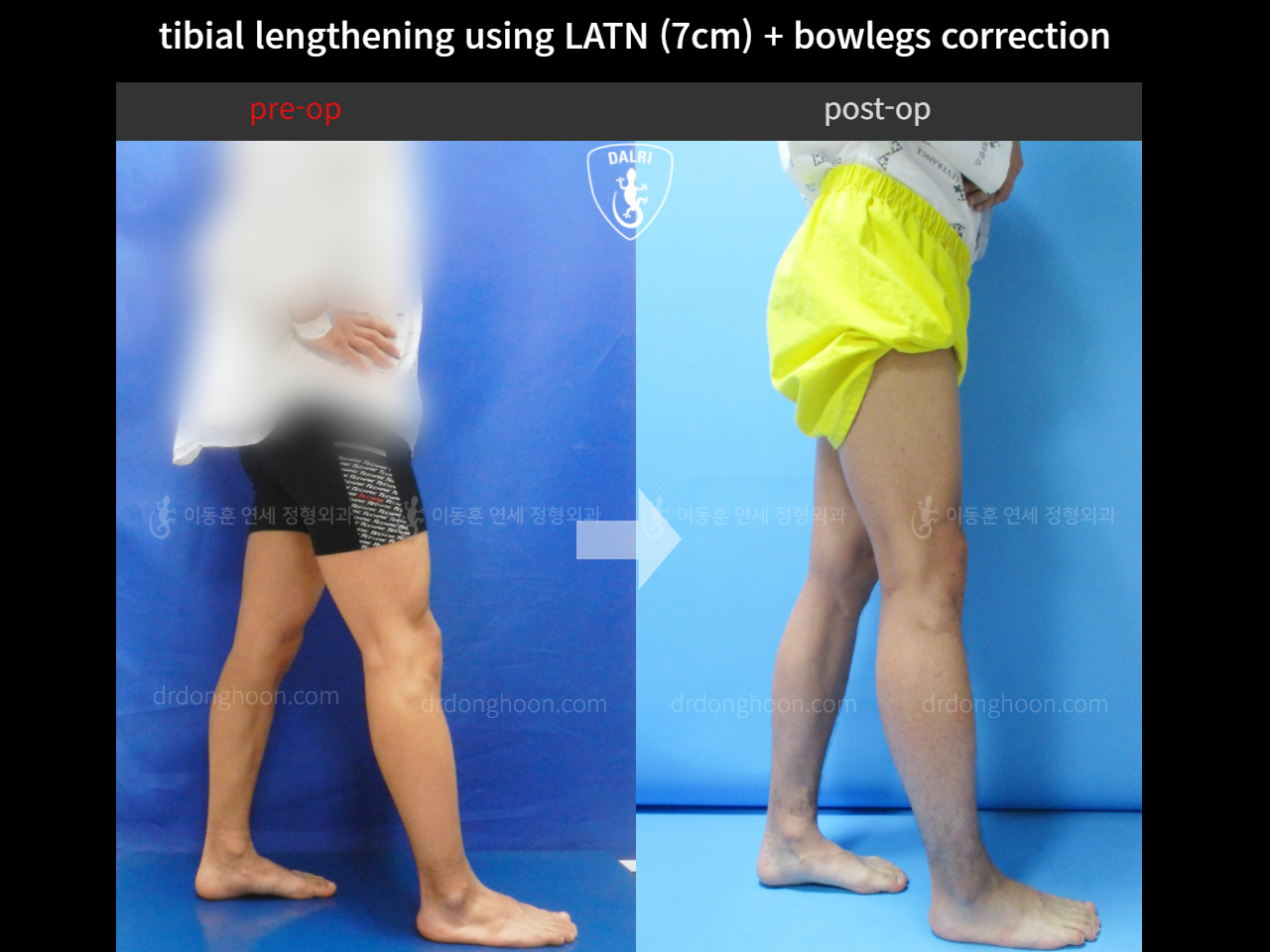 Before and after cll + deformity correction, case 4323114, image 3, Dr. Donghoon institute (DALRI)