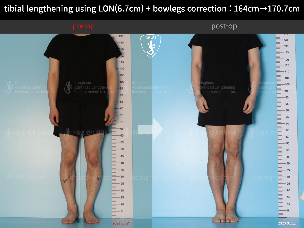 Before and after cll + deformity correction, case 13914972, image 1, Dr. Donghoon institute (DALRI)