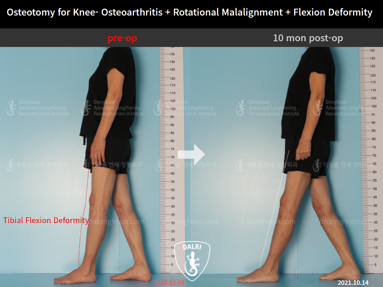 Before and after osteotomy for knee osteoarthritis, case 9128503, image 5, Dr. Donghoon institute (DALRI)