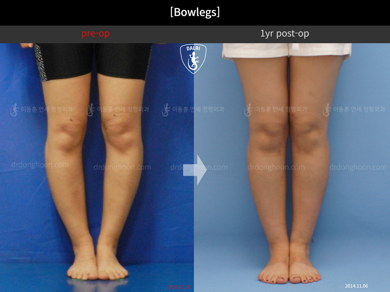 Before and after adult bowlegs, case 12505161, image 3, Dr. Donghoon institute (DALRI)