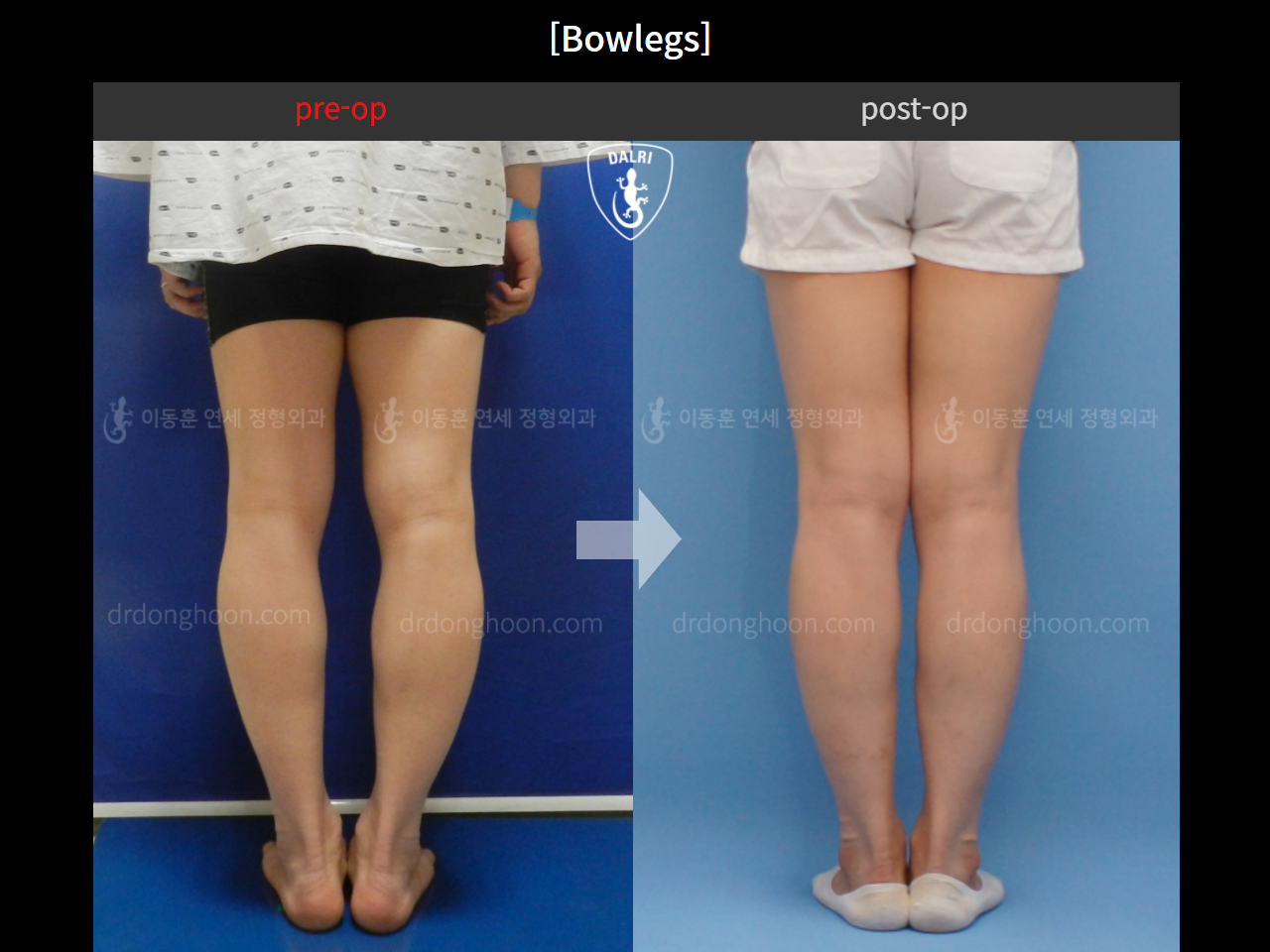 Before and after adult bowlegs, case 4311021, image 4, Dr. Donghoon institute (DALRI)