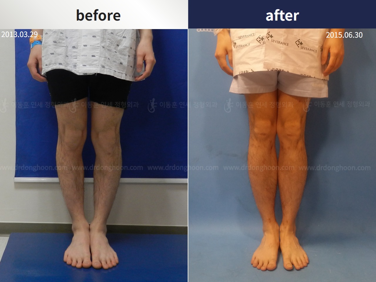 Before and after cll + deformity correction, case 4323089, image 1, Dr. Donghoon institute (DALRI)