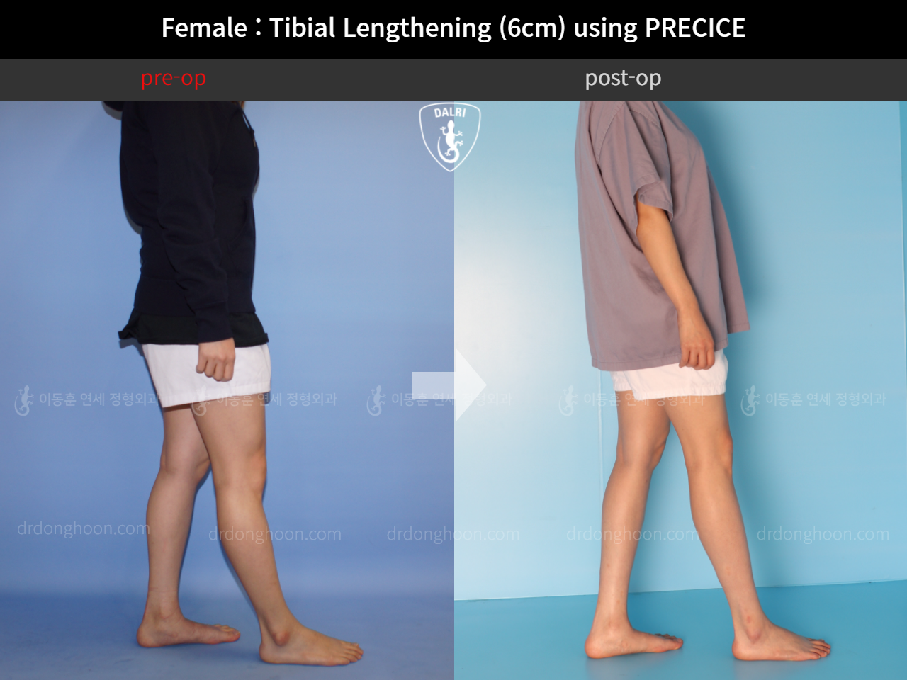 Before and after cll precice, case 11653827, image 4, Dr. Donghoon institute (DALRI)