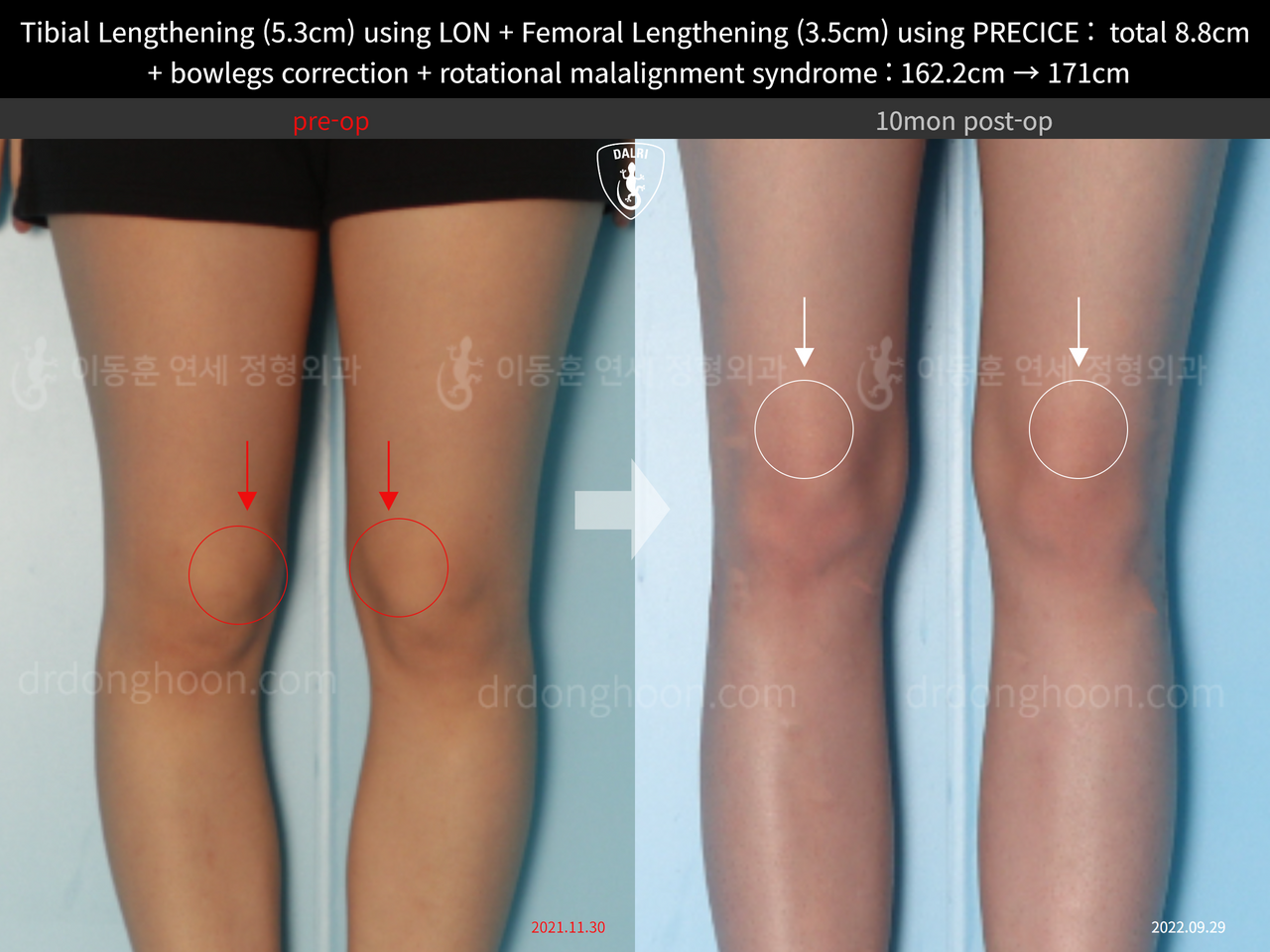 Before and after cll + deformity correction, case 13127167, image 3, Dr. Donghoon institute (DALRI)