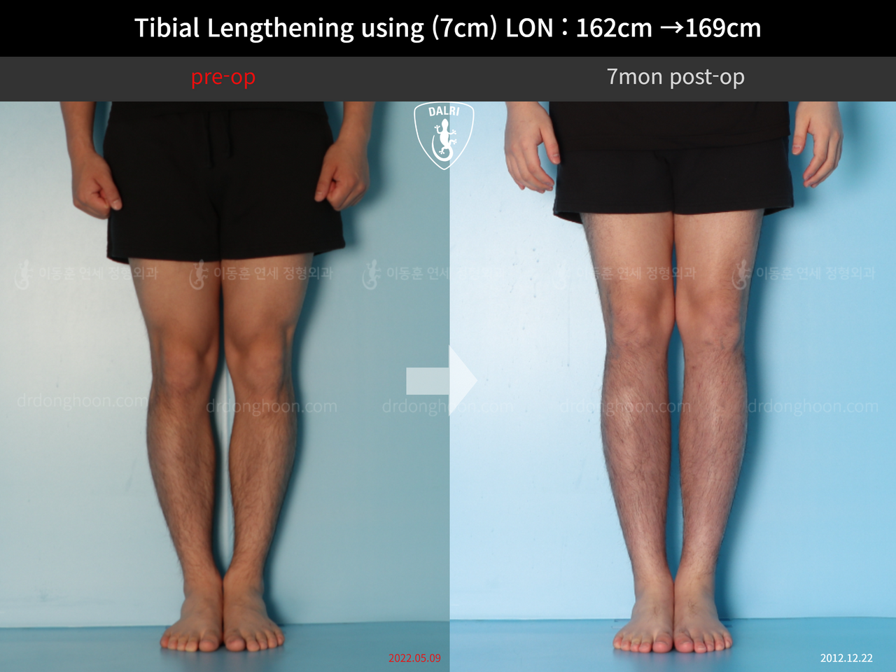 Before and after cll lon, case 13743472, image 9, Dr. Donghoon institute (DALRI)