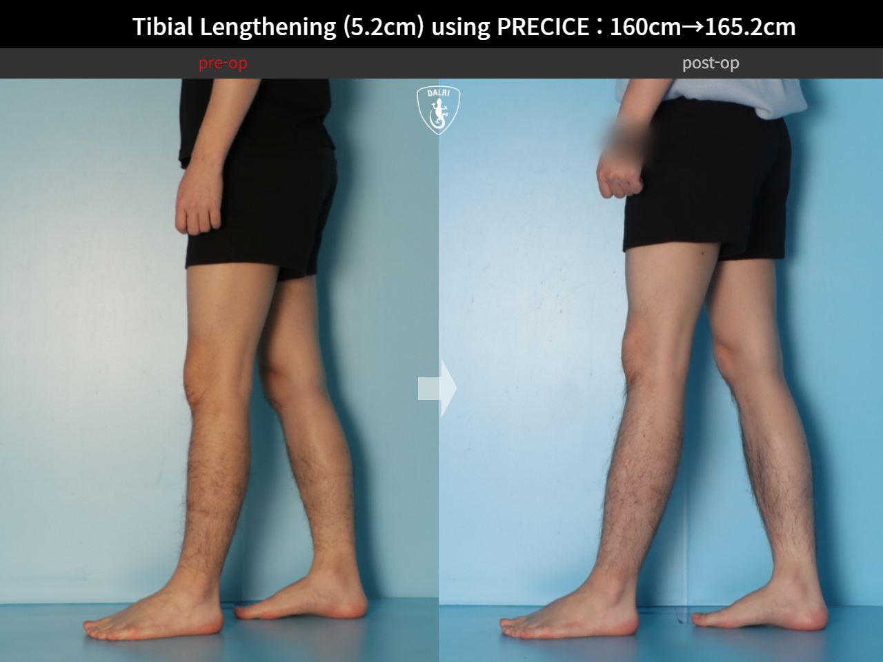 Before and after cll precice, case 27370351, image 8, Dr. Donghoon institute (DALRI)