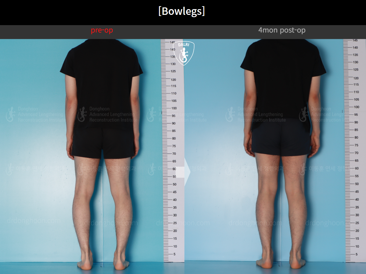 Before and after adult bowlegs, case 21098909, image 5, Dr. Donghoon institute (DALRI)