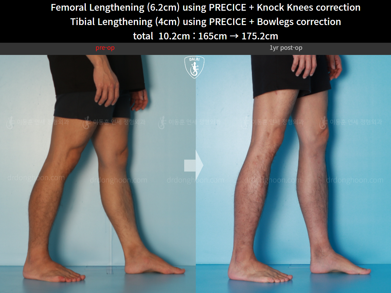 Before and after cll + deformity correction, case 15903252, image 12, Dr. Donghoon institute (DALRI)