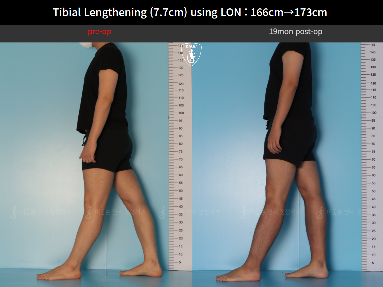 Before and after cll lon, case 126858222, image 3, Dr. Donghoon institute (DALRI)