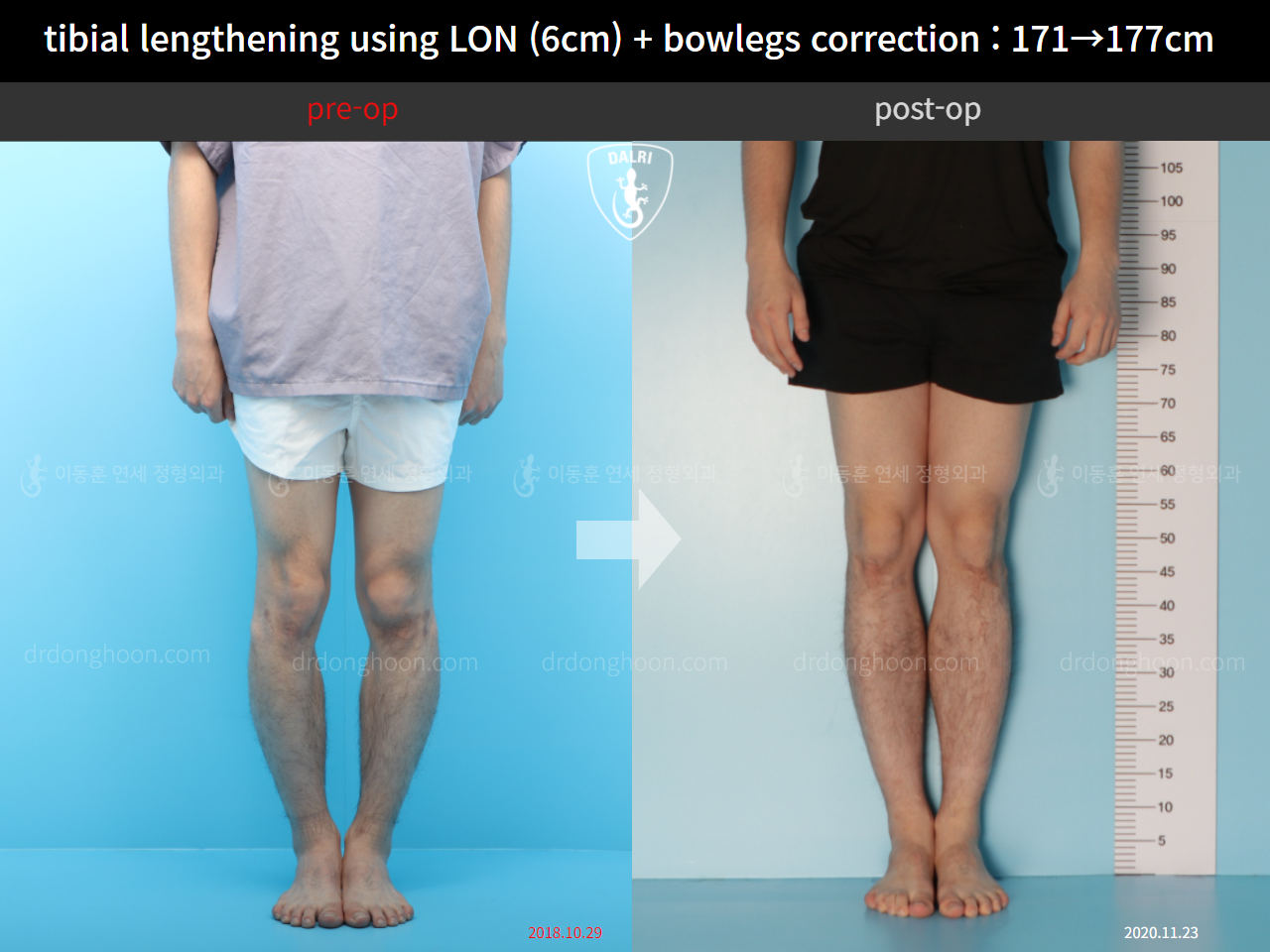 Before and after cll + deformity correction, case 11798378, image 1, Dr. Donghoon institute (DALRI)