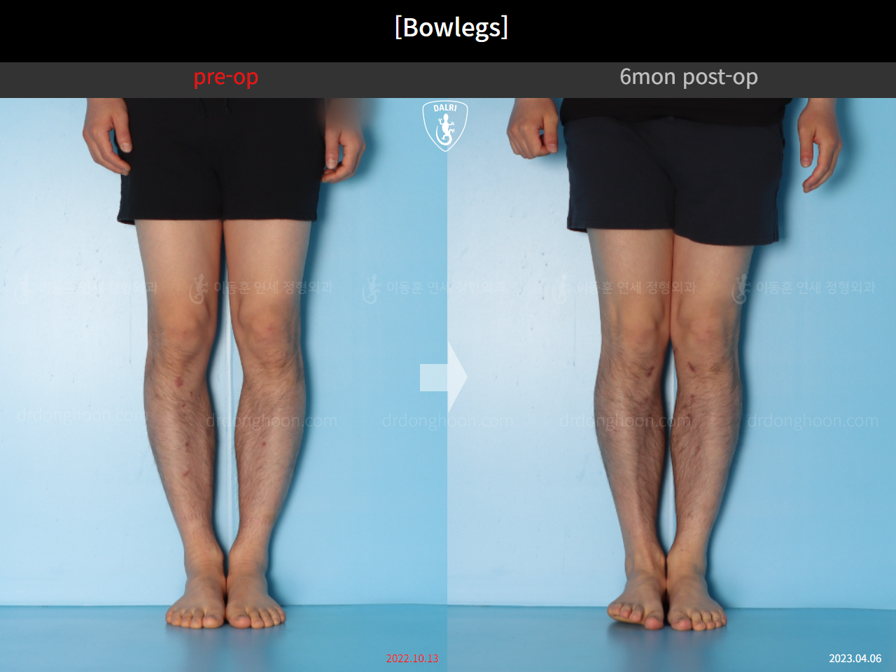 Before and after adult bowlegs, case 14742489, image 7, Dr. Donghoon institute (DALRI)