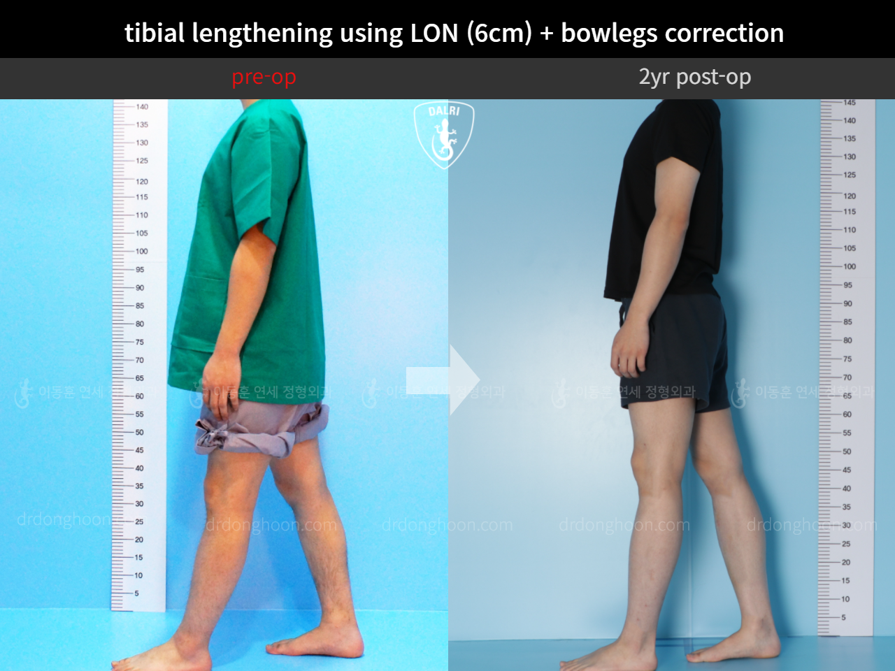 Before and after cll + deformity correction, case 4323141, image 4, Dr. Donghoon institute (DALRI)