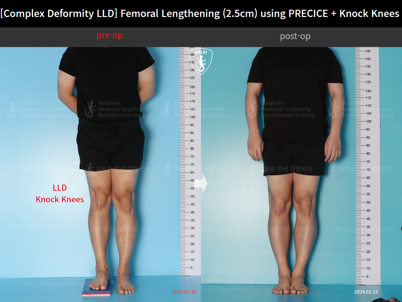 Before and after complex deformity, case 17589126, image 1, Dr. Donghoon institute (DALRI)