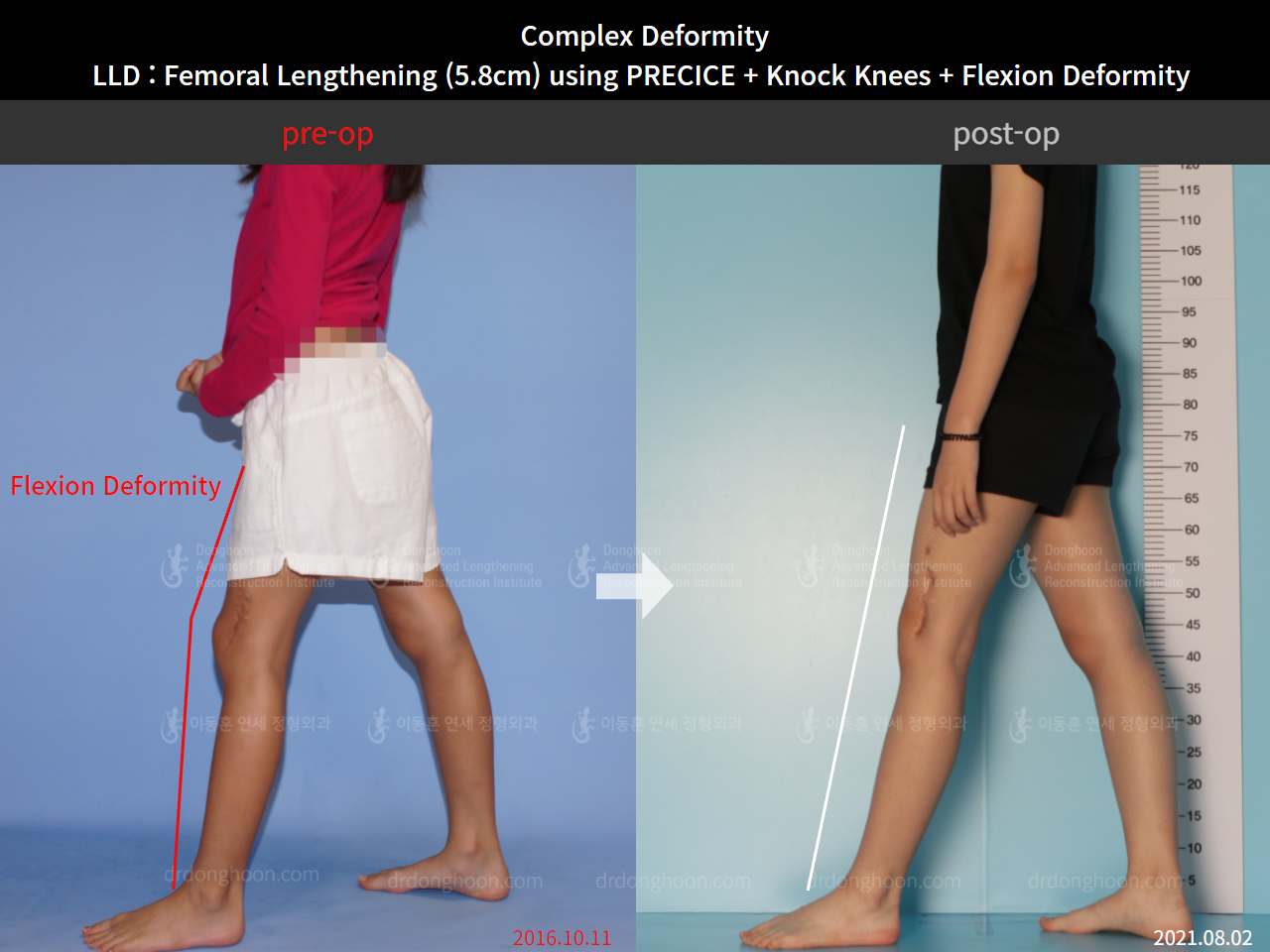Before and after complex deformity, case 8790512, image 5, Dr. Donghoon institute (DALRI)