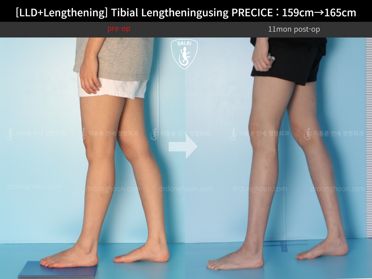 Before and after cll precice, case 13252418, image 7, Dr. Donghoon institute (DALRI)