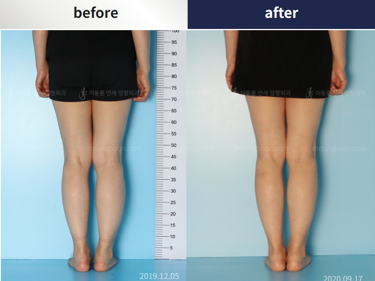 Before and after osteotomy for knee osteoarthritis, case 5203391, image 4, Dr. Donghoon institute (DALRI)
