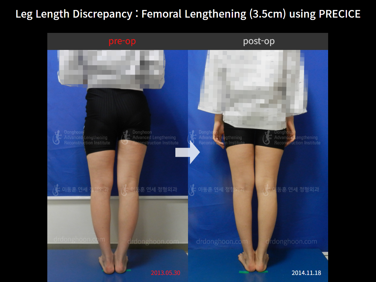 Before and after adult lld, case 4320329, image 2, Dr. Donghoon institute (DALRI)