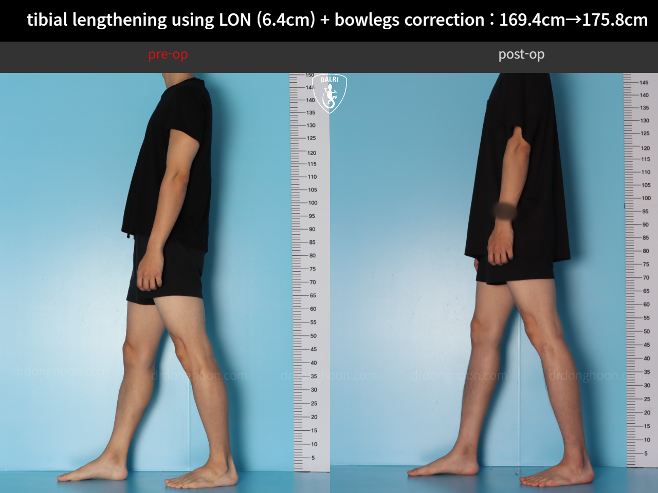 Before and after cll + deformity correction, case 36736776, image 6, Dr. Donghoon institute (DALRI)