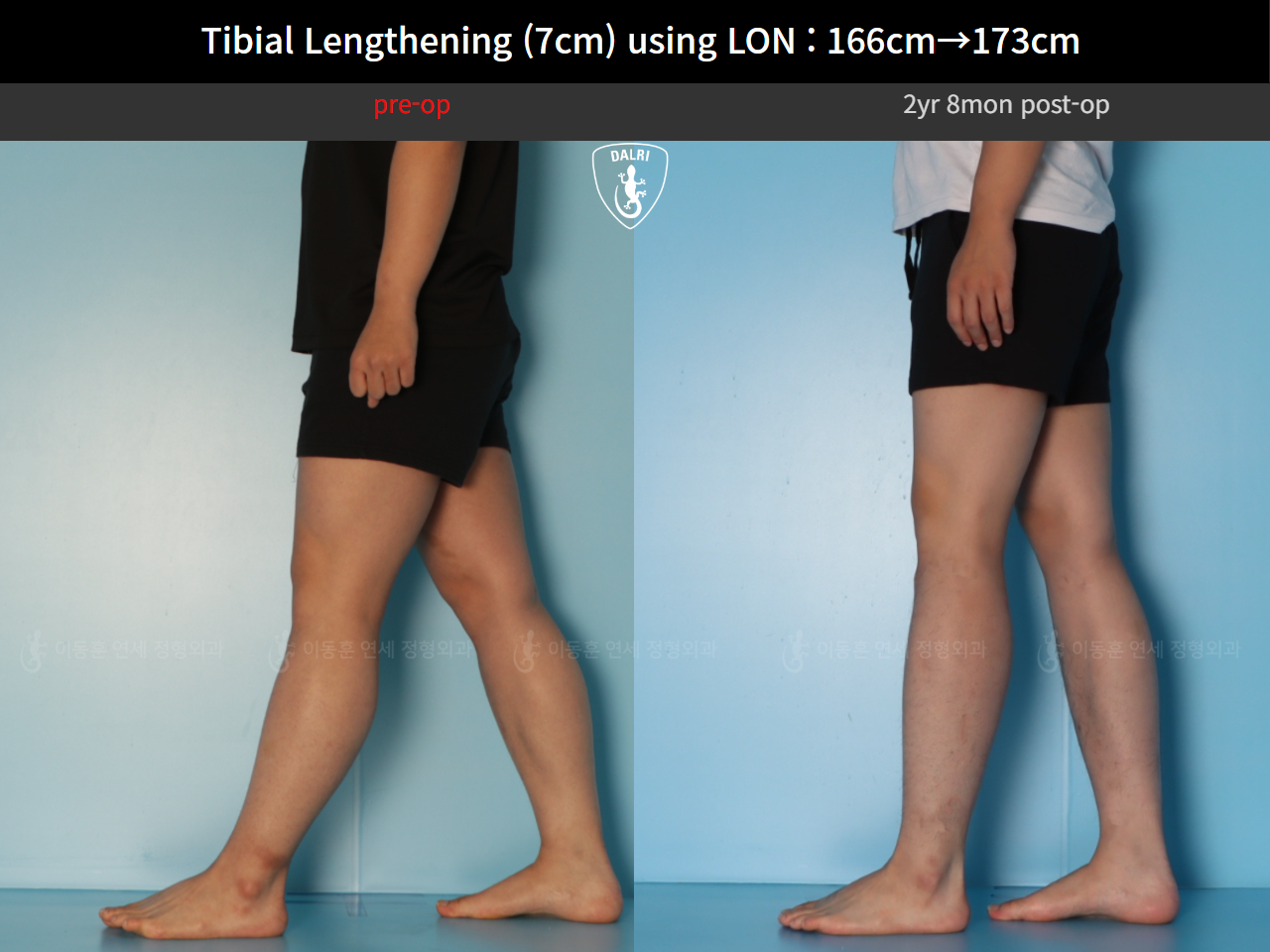 Before and after cll lon, case 127679780, image 7, Dr. Donghoon institute (DALRI)