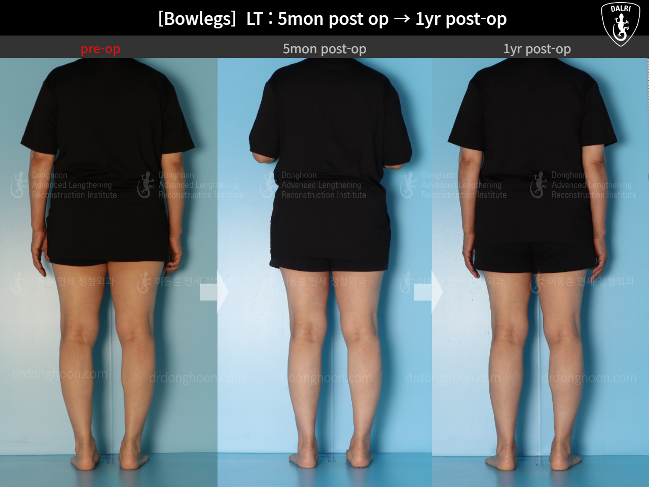 Before and after adult bowlegs, case 15172734, image 5, Dr. Donghoon institute (DALRI)