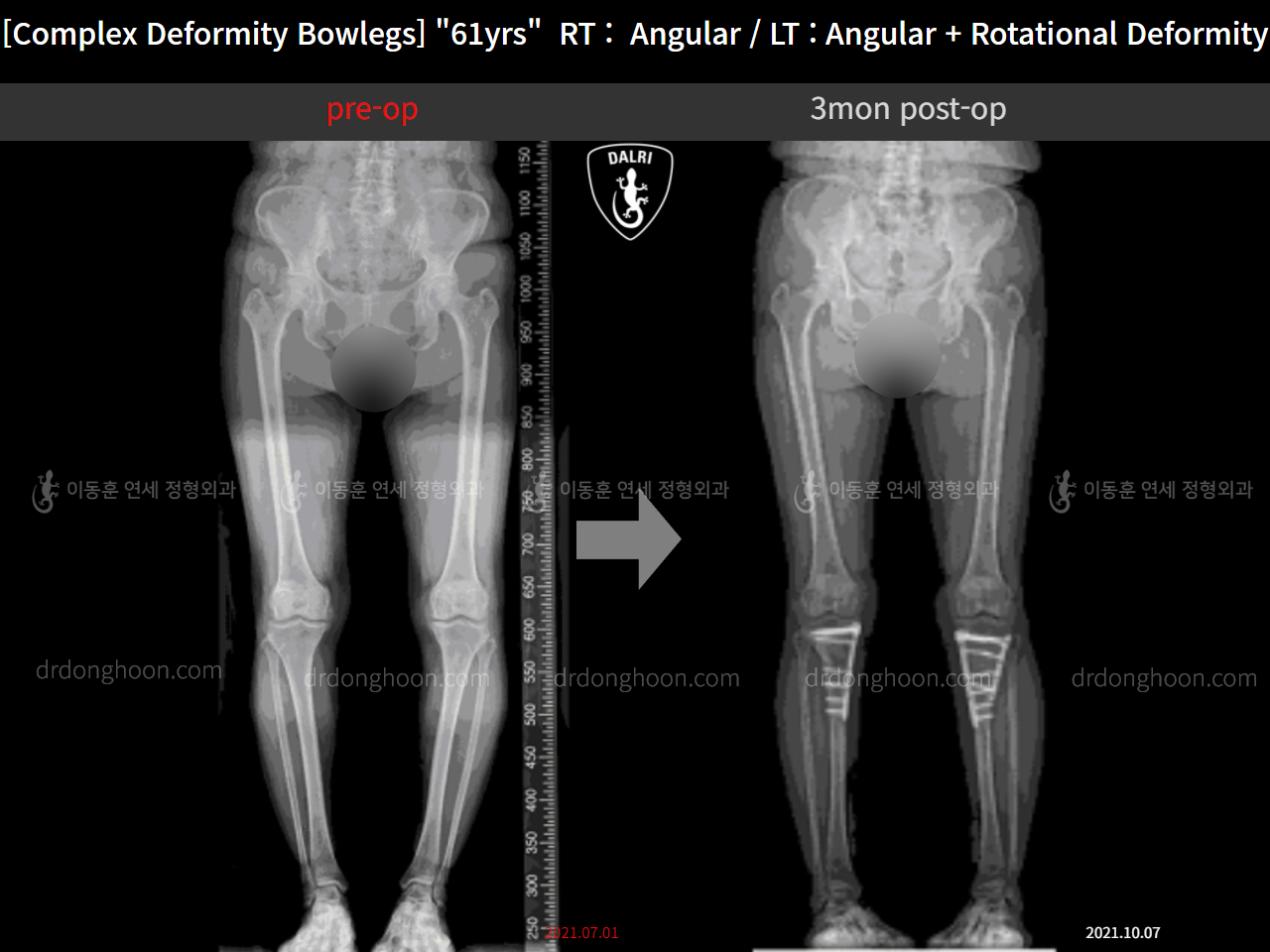 Before and after adult bowlegs, case 11576427, image 7, Dr. Donghoon institute (DALRI)