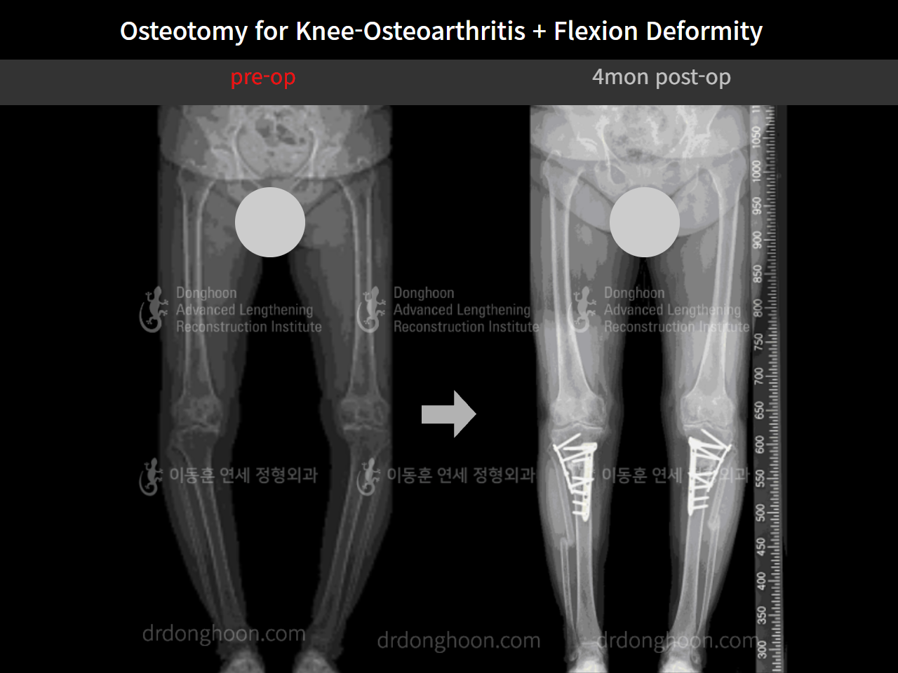 Before and after osteotomy for knee osteoarthritis, case 8803663, image 6, Dr. Donghoon institute (DALRI)