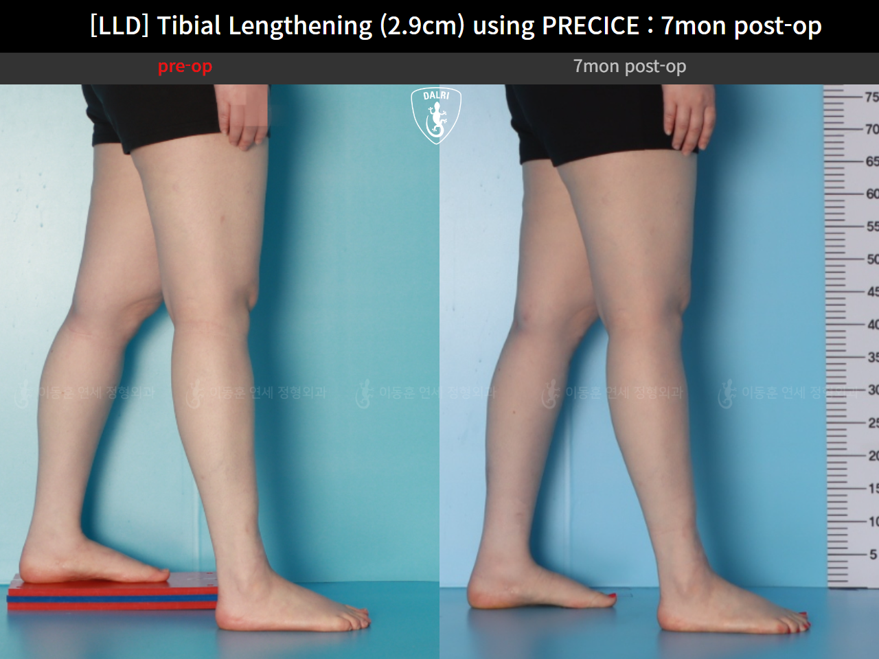 Before and after adult lld, case 62389039, image 8, Dr. Donghoon institute (DALRI)