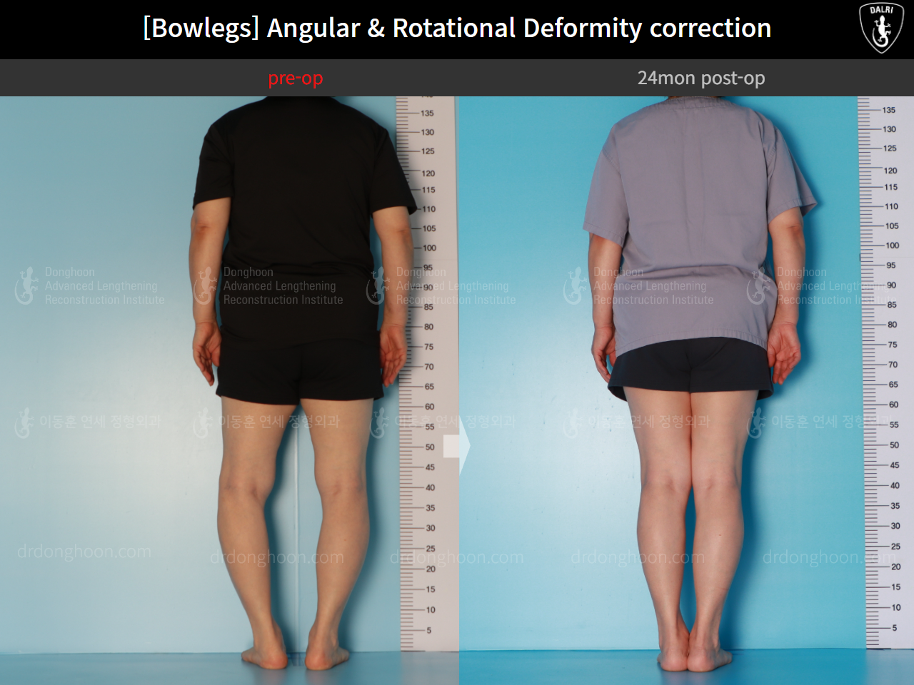 Before and after osteotomy for knee osteoarthritis, case 16074487, image 4, Dr. Donghoon institute (DALRI)
