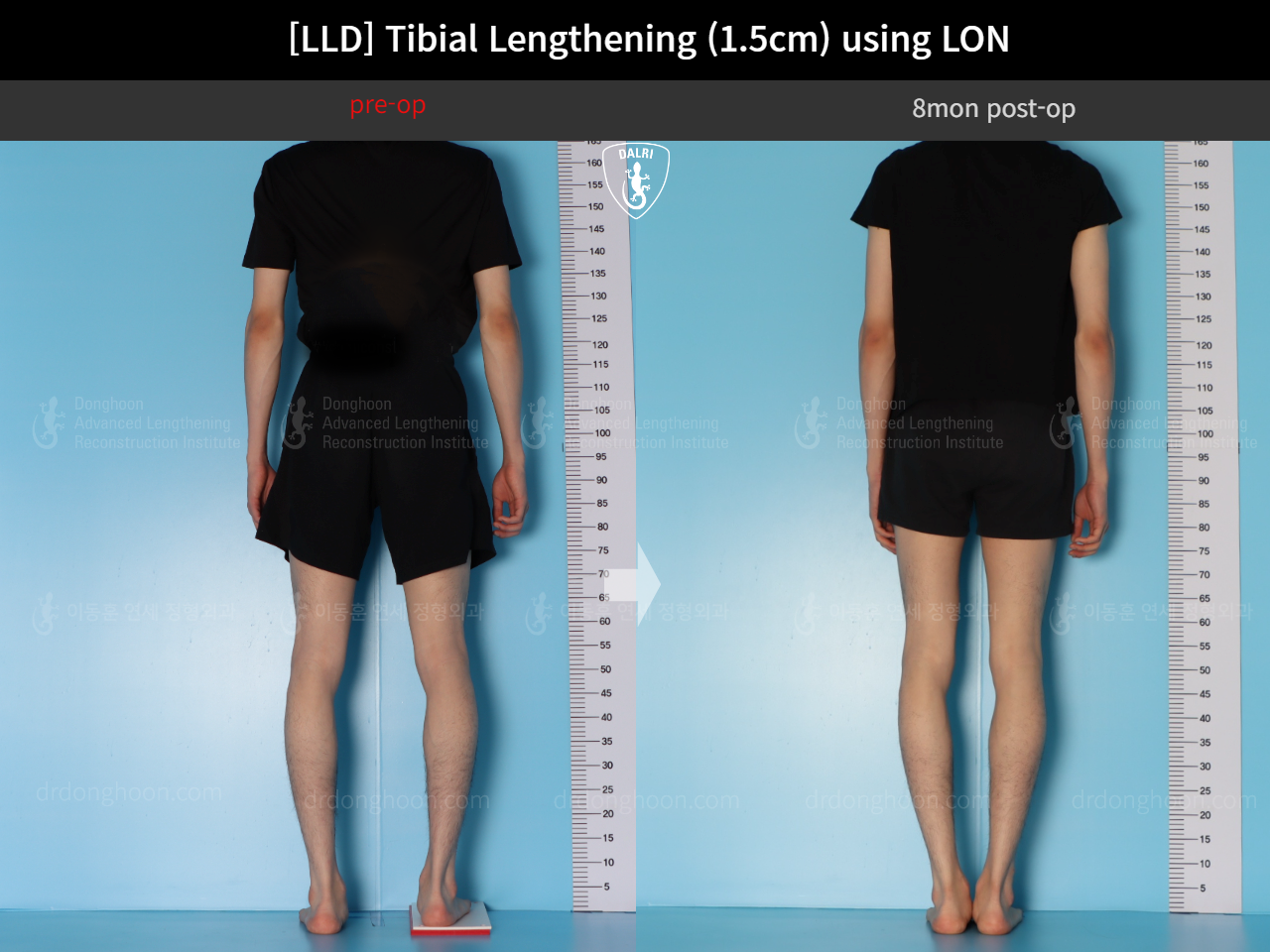 Before and after adult lld, case 18244334, image 2, Dr. Donghoon institute (DALRI)