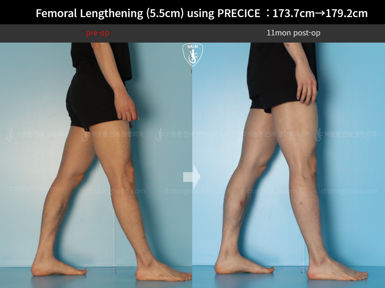 Before and after cll precice, case 18140453, image 10, Dr. Donghoon institute (DALRI)