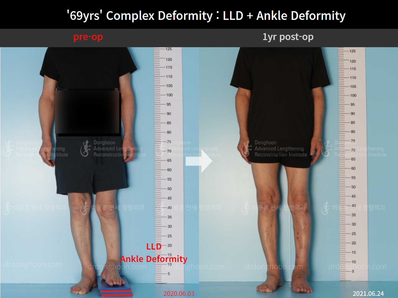 Before and after adult lld, case 8981713, image 1, Dr. Donghoon institute (DALRI)