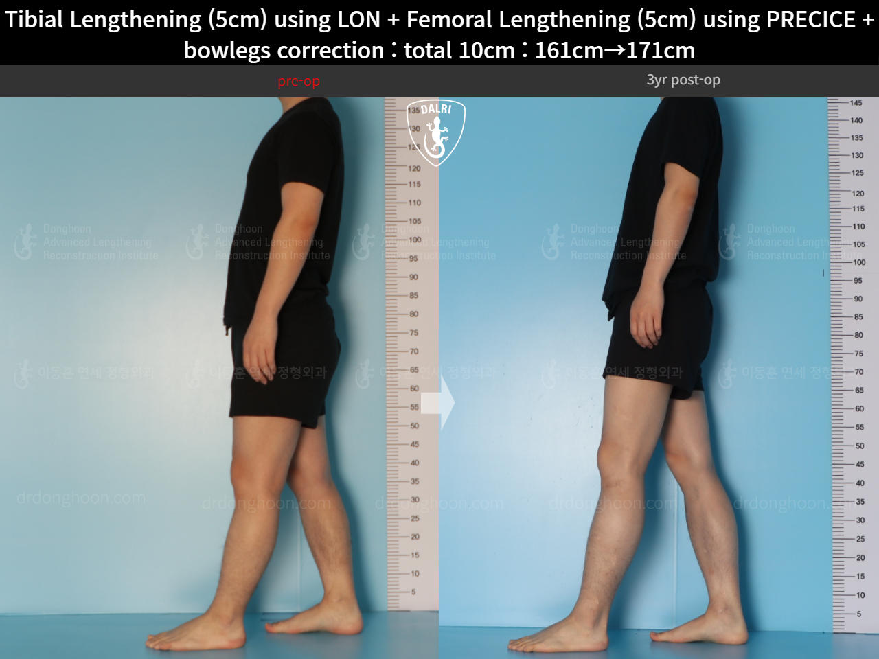 Before and after cll + deformity correction, case 22208435, image 5, Dr. Donghoon institute (DALRI)