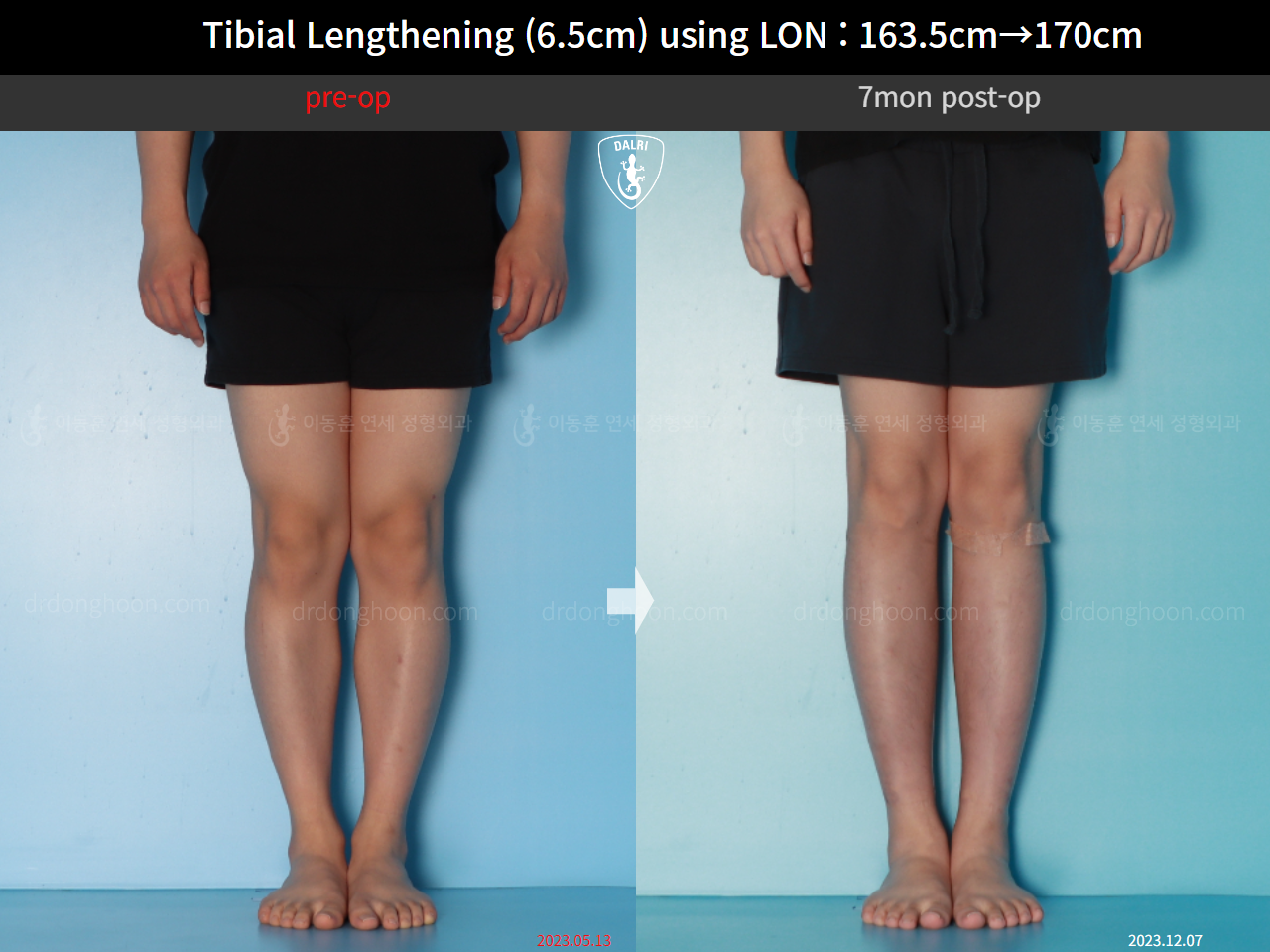 Before and after cll lon, case 17199046, image 5, Dr. Donghoon institute (DALRI)