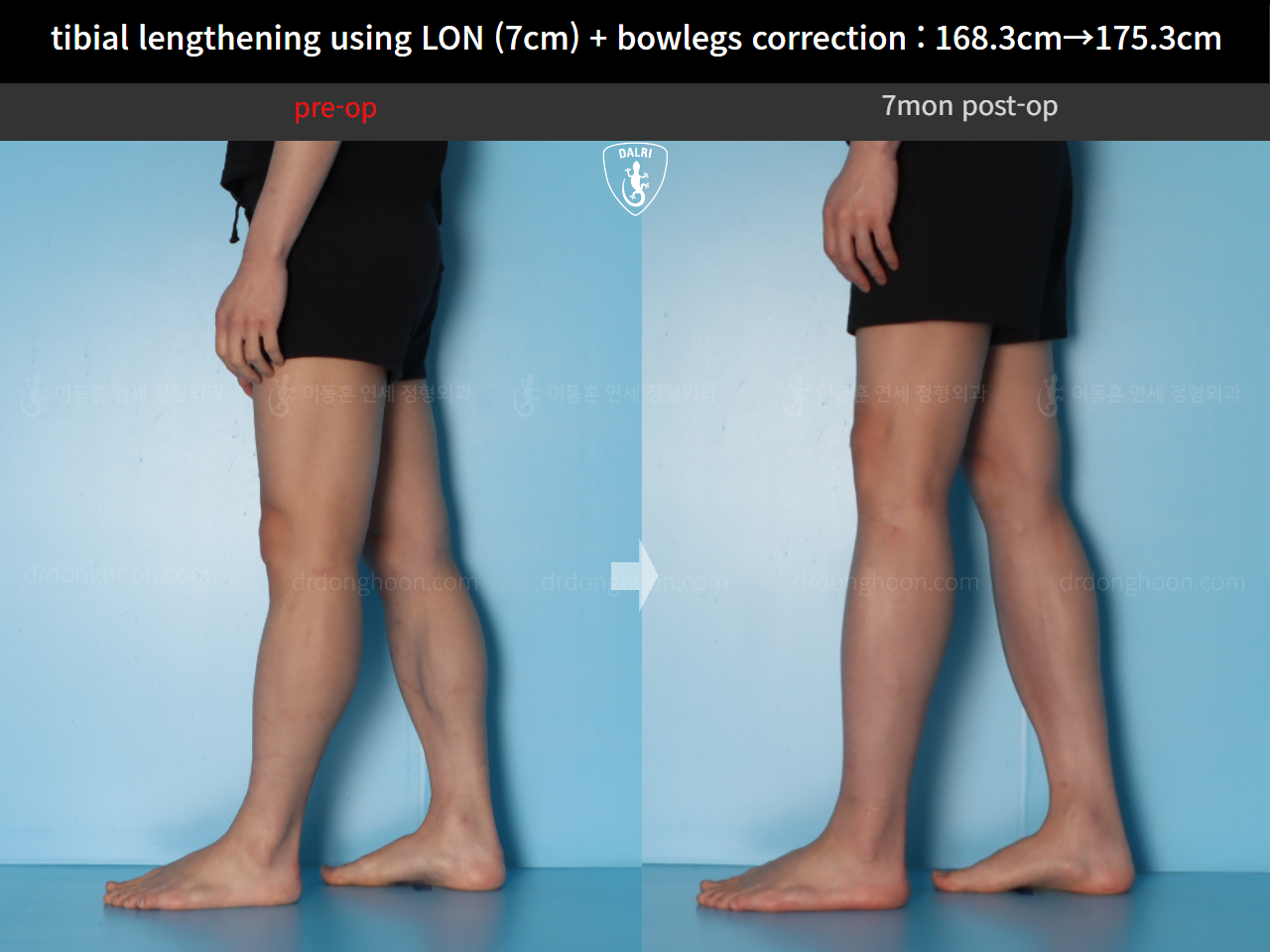 Before and after cll + deformity correction, case 21918246, image 9, Dr. Donghoon institute (DALRI)