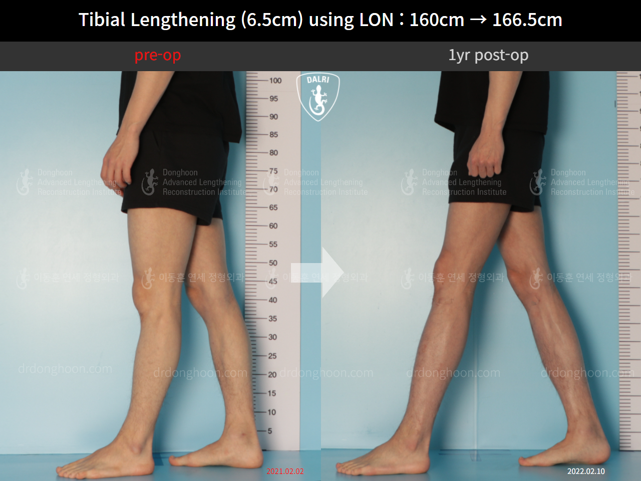 Before and after cll lon, case 10293105, image 7, Dr. Donghoon institute (DALRI)