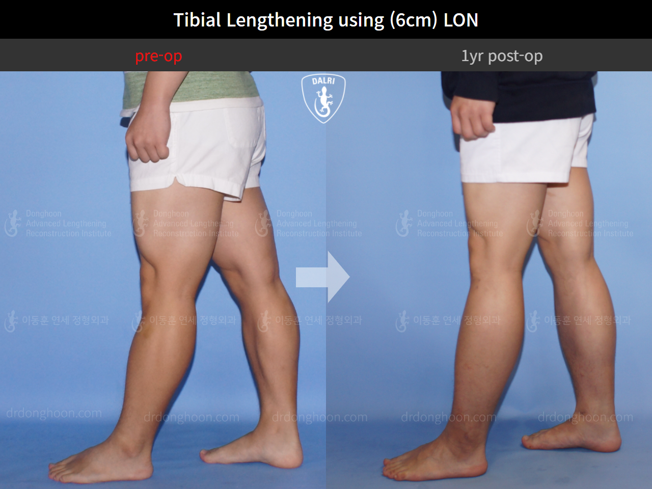 Before and after cll lon, case 4323461, image 7, Dr. Donghoon institute (DALRI)
