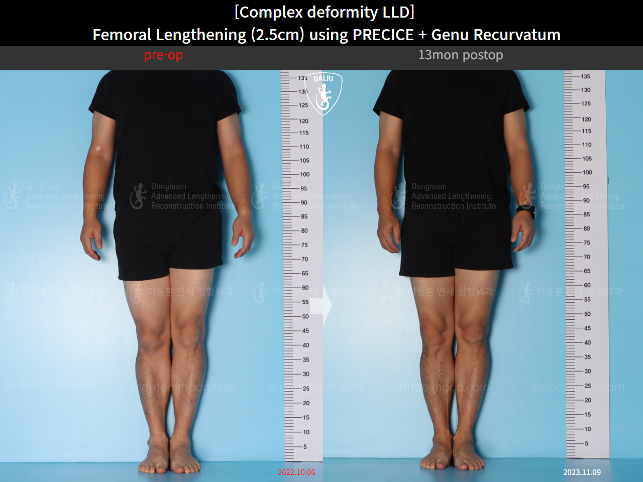 Before and after adult lld, case 16854698, image 3, Dr. Donghoon institute (DALRI)
