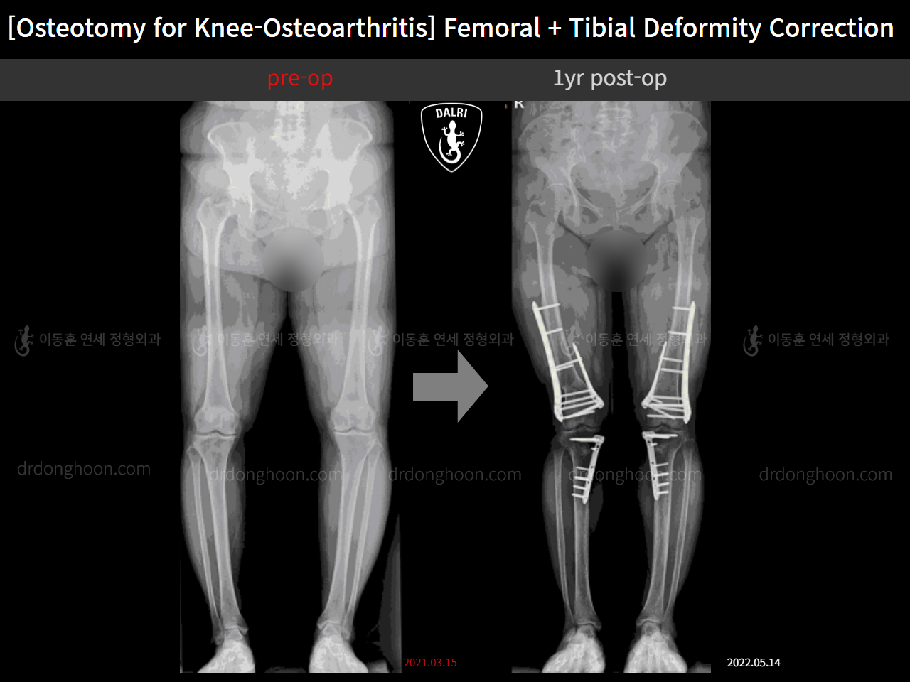 Before and after osteotomy for knee osteoarthritis, case 11512420, image 1, Dr. Donghoon institute (DALRI)
