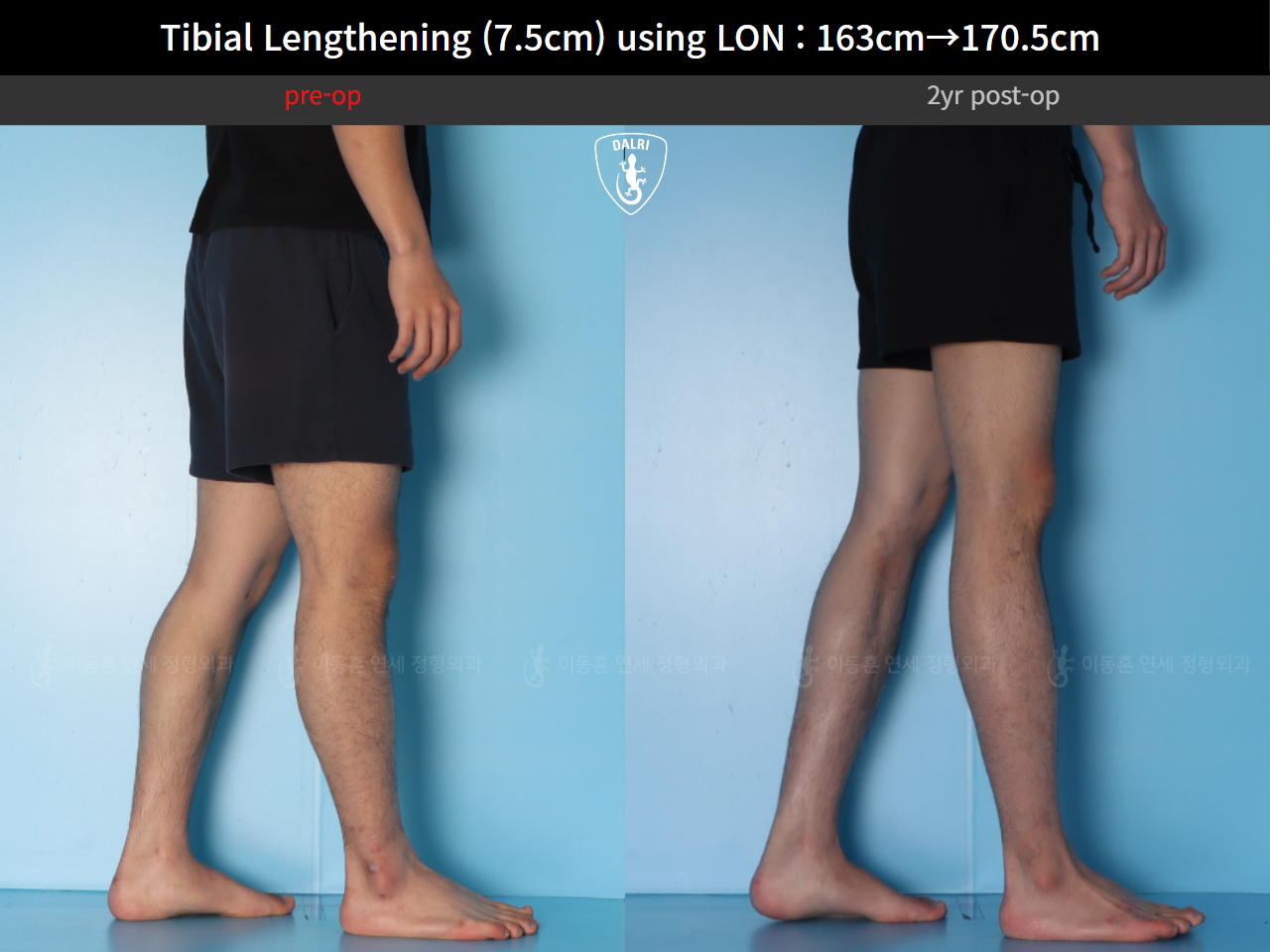 Before and after cll lon, case 125785462, image 12, Dr. Donghoon institute (DALRI)