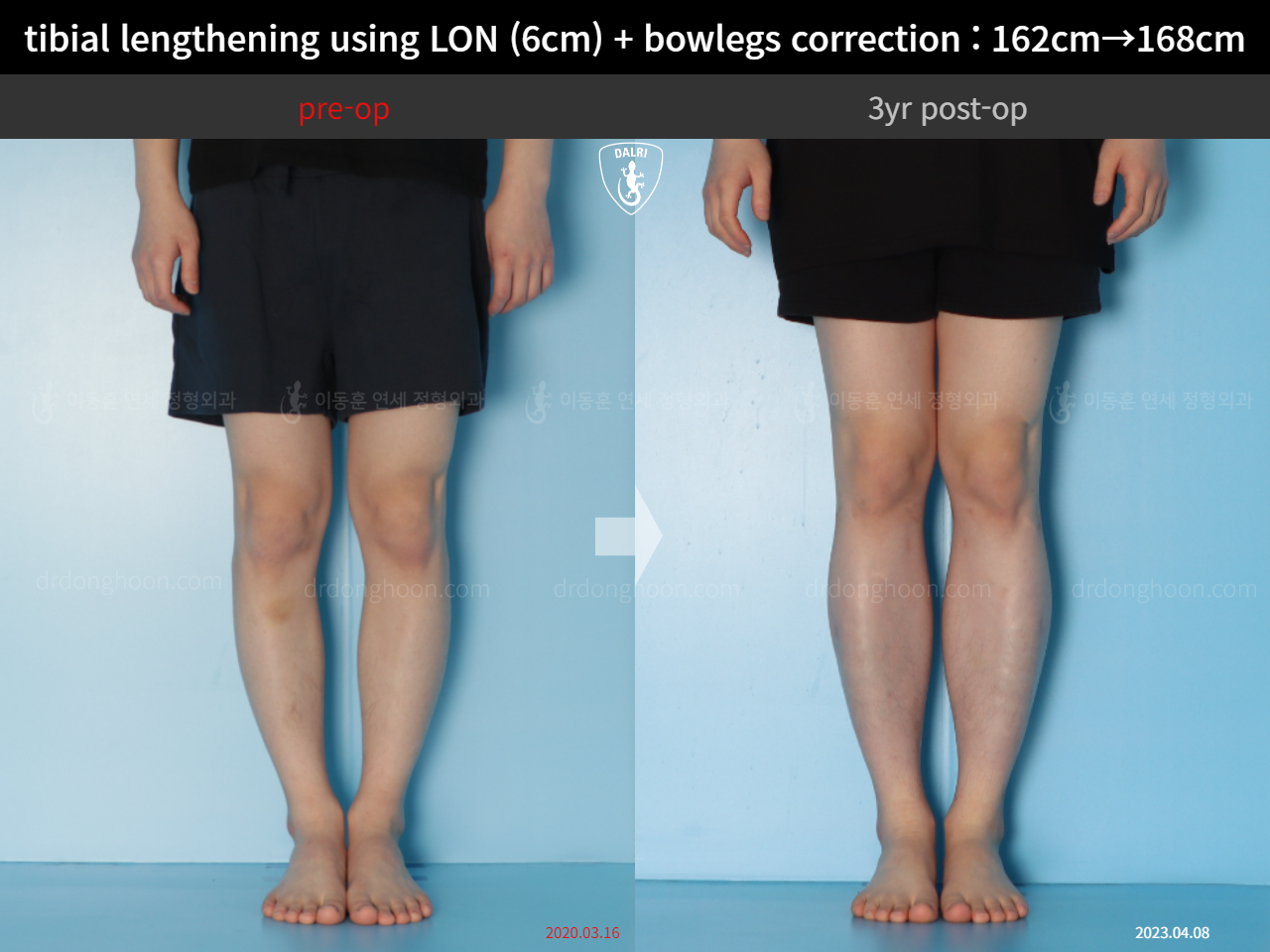 Before and after cll + deformity correction, case 14731799, image 5, Dr. Donghoon institute (DALRI)