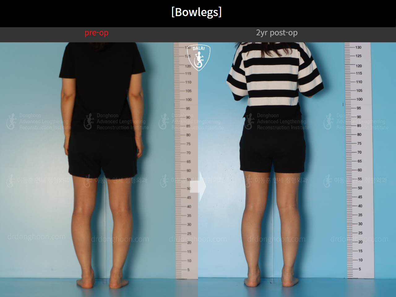 Before and after adult bowlegs, case 20942169, image 5, Dr. Donghoon institute (DALRI)