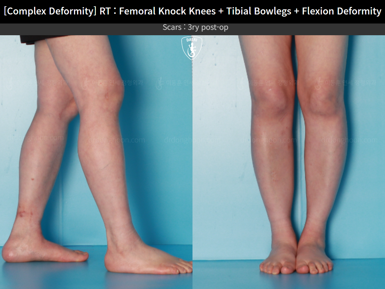 Before and after adult knock knees, case 16507042, image 9, Dr. Donghoon institute (DALRI)