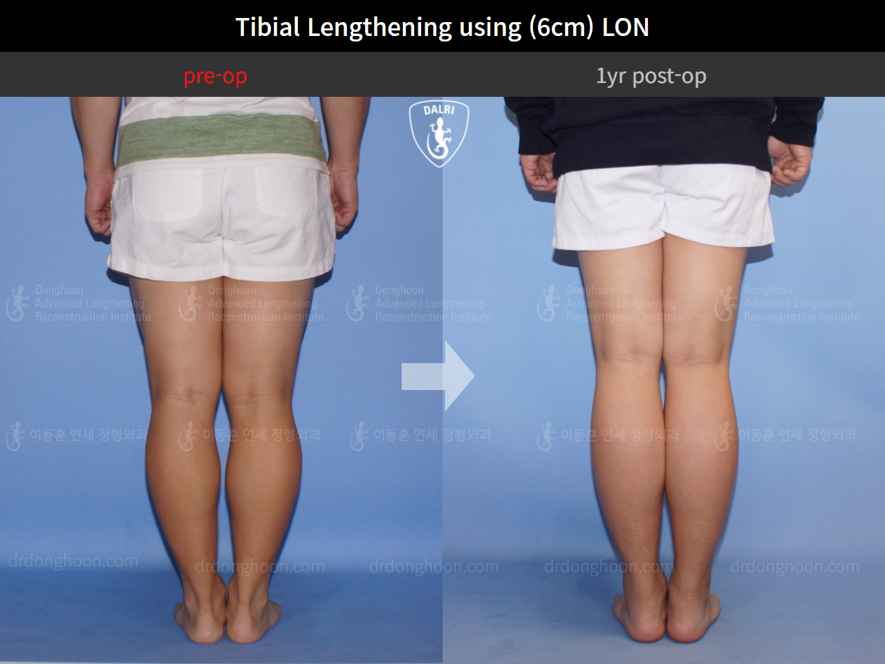 Before and after cll lon, case 4323461, image 6, Dr. Donghoon institute (DALRI)