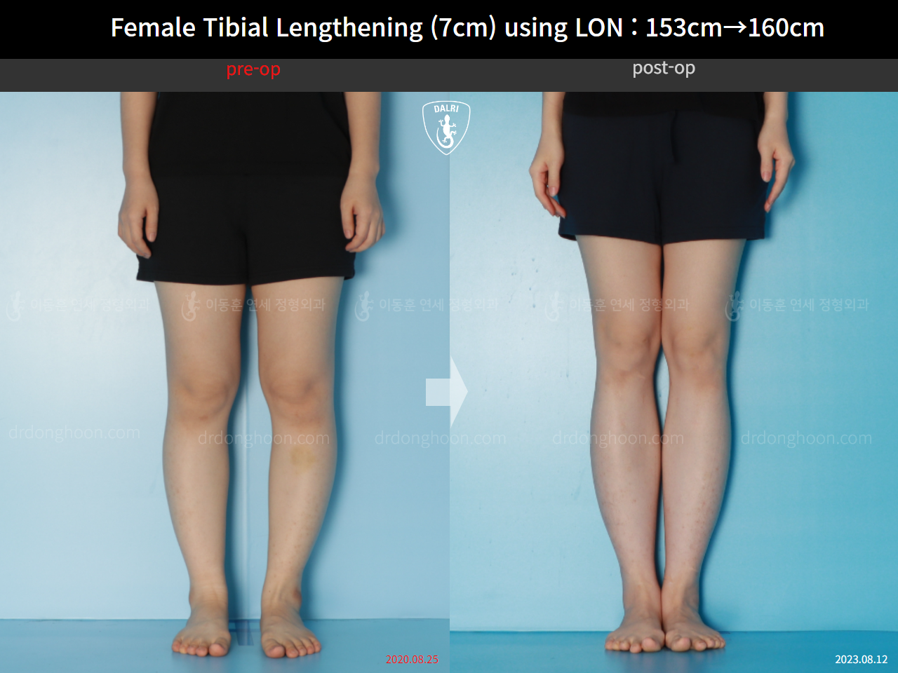 Before and after cll lon, case 16044134, image 5, Dr. Donghoon institute (DALRI)
