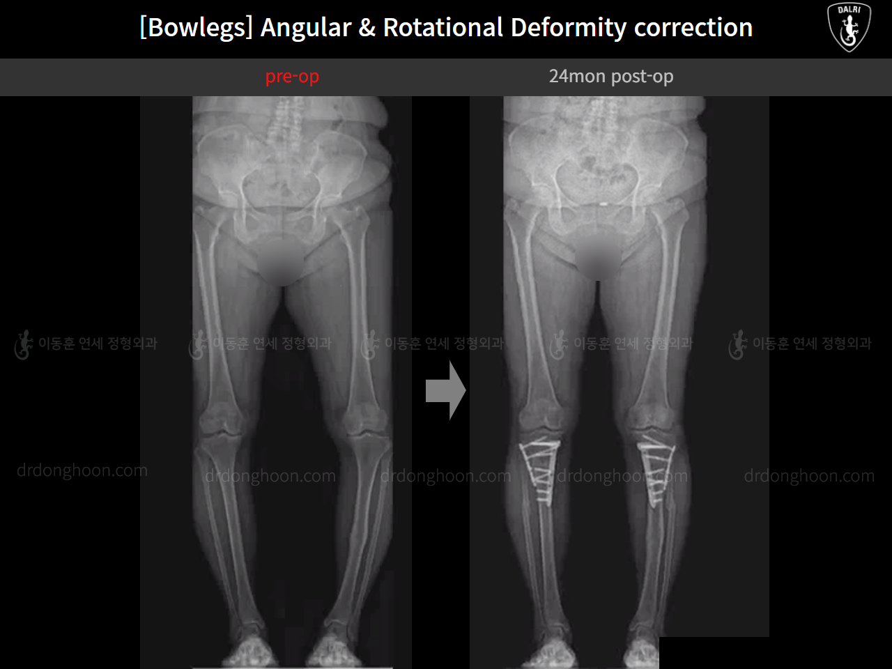 Before and after osteotomy for knee osteoarthritis, case 16074487, image 9, Dr. Donghoon institute (DALRI)