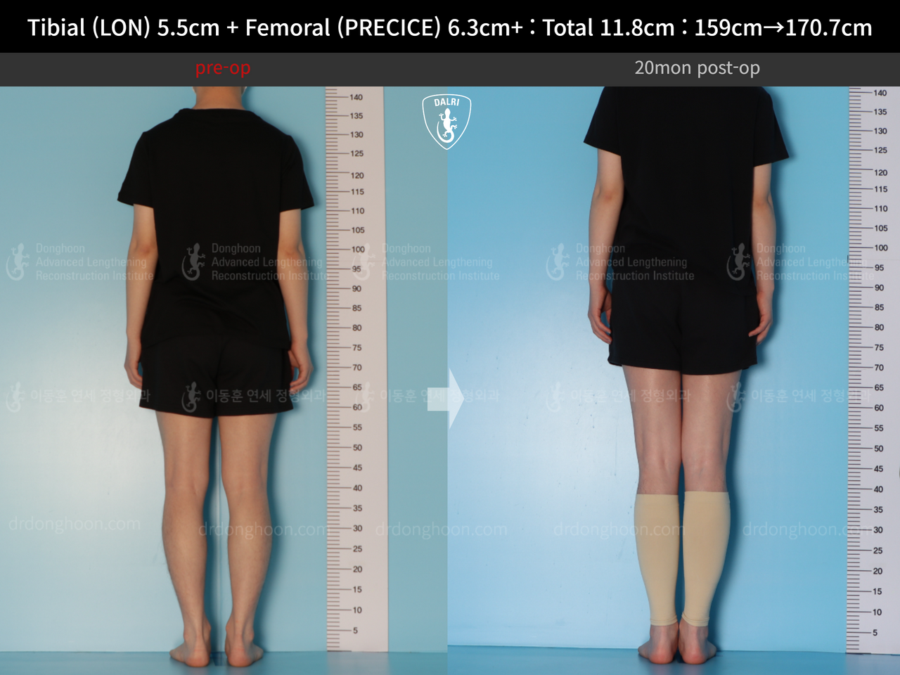 Before and after cll precice, case 14390078, image 4, Dr. Donghoon institute (DALRI)