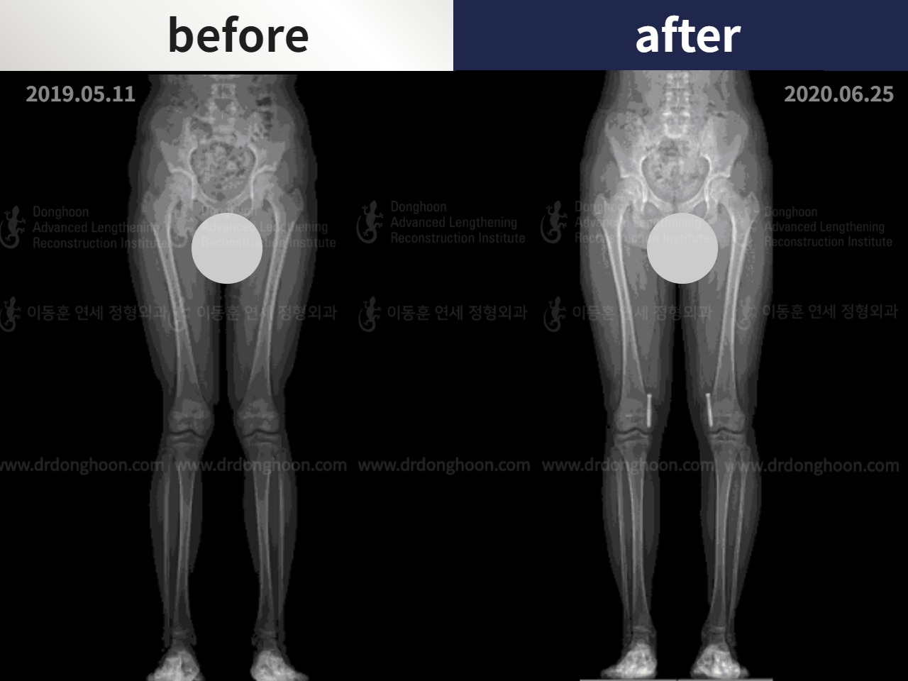 Before and after paediatric & adolescent knock knees, case 4640482, image 3, Dr. Donghoon institute (DALRI)