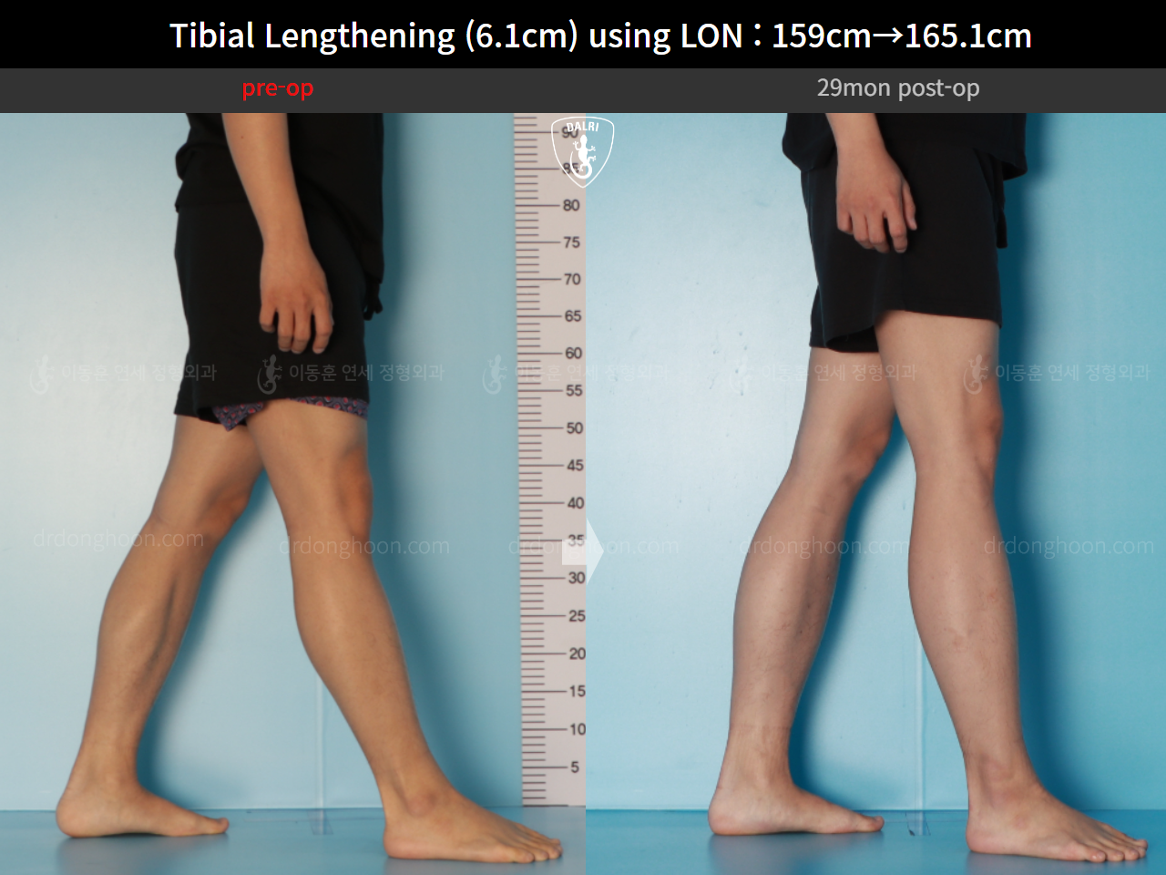 Before and after cll lon, case 16723424, image 9, Dr. Donghoon institute (DALRI)